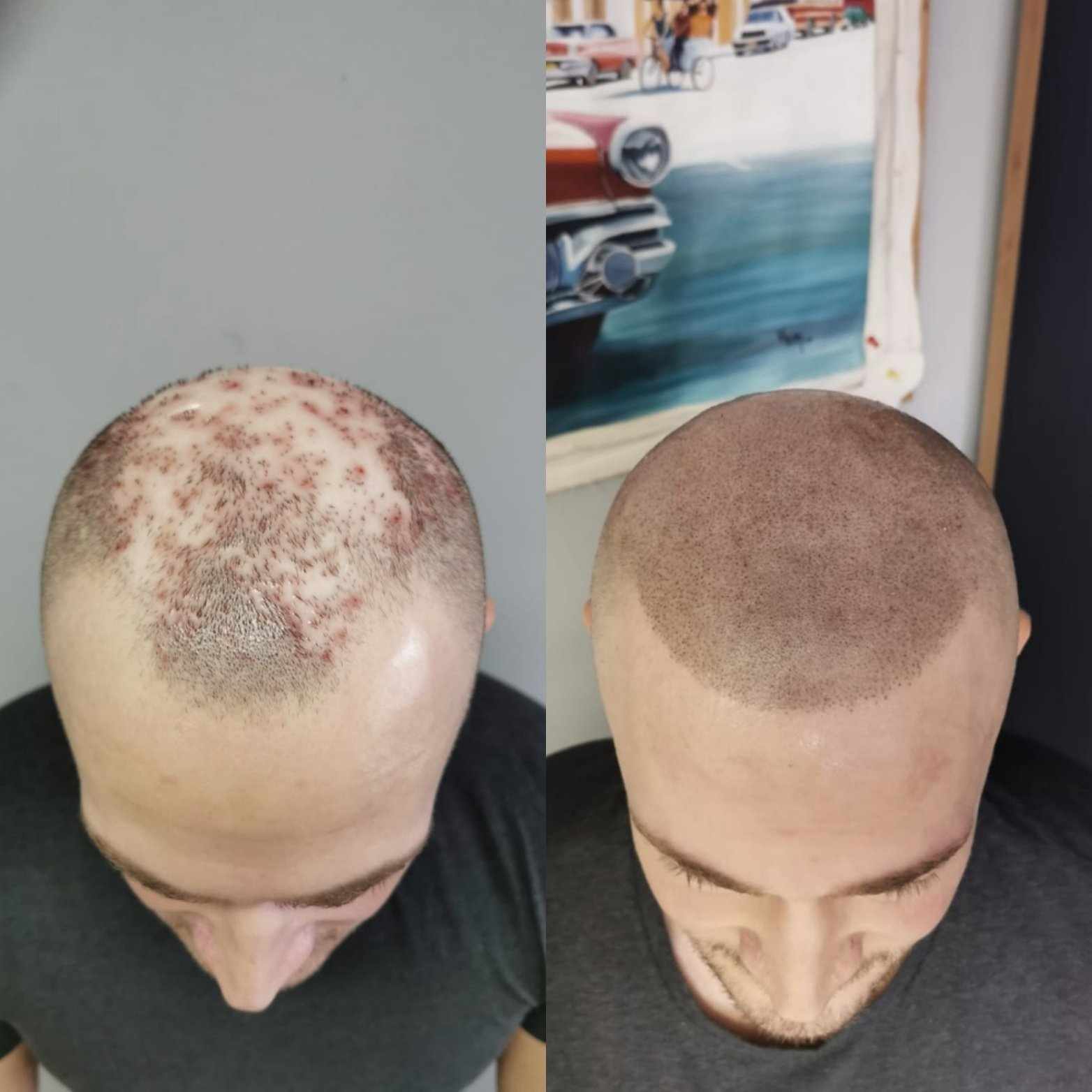 Mikropigmentace pomáhá při alopecii