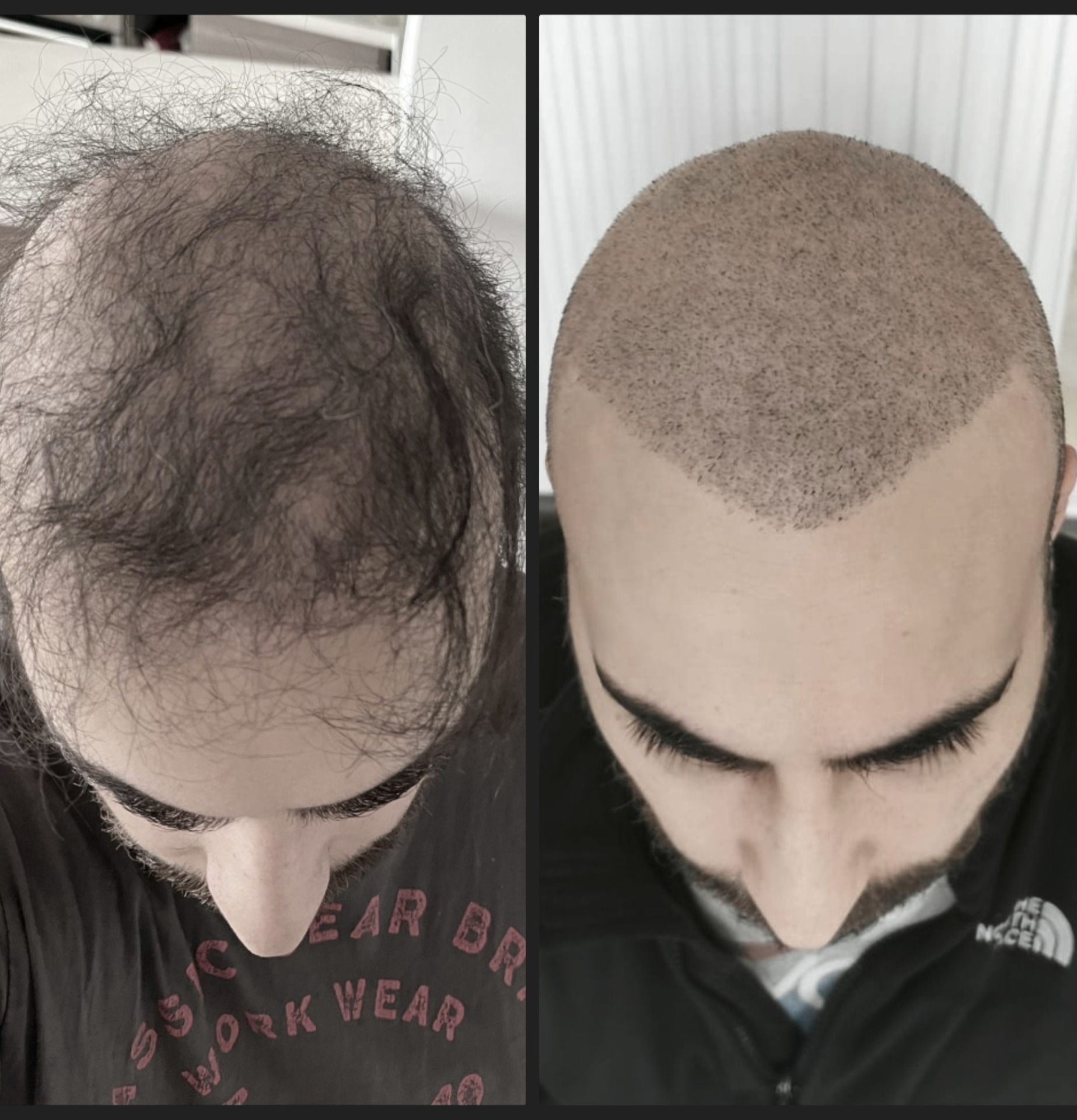 Když transplantace nesplní očekávání